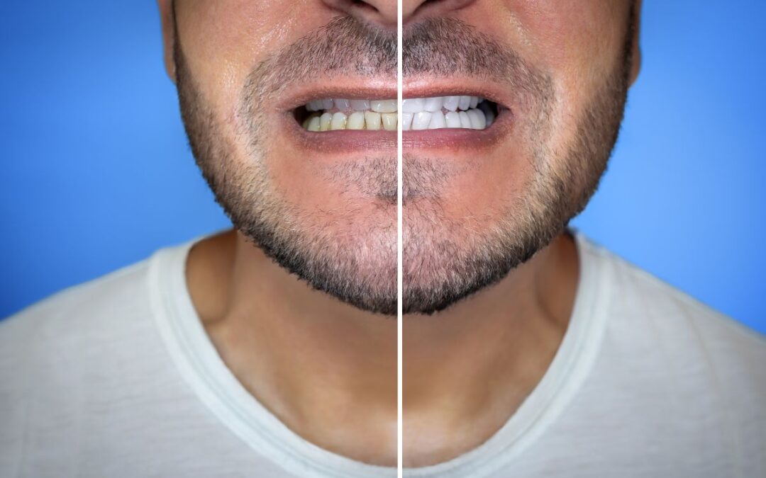 Why Your At-Home Teeth Whitening Doesn’t Work?
