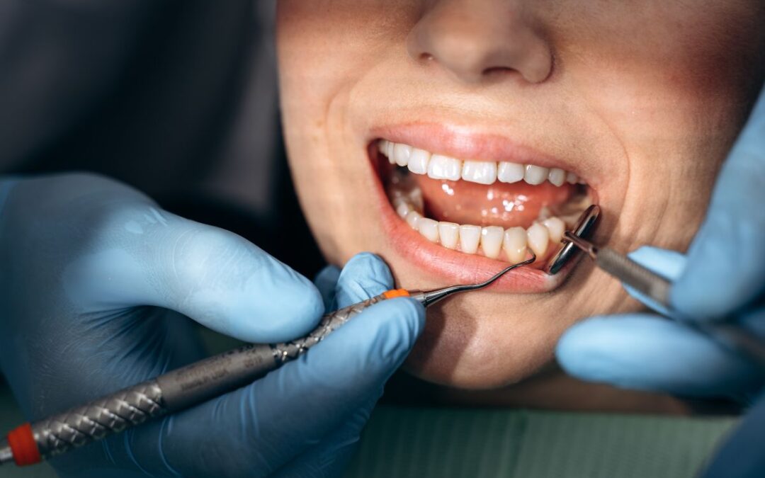 5 Ways You Can Prevent Cavities From Forming
