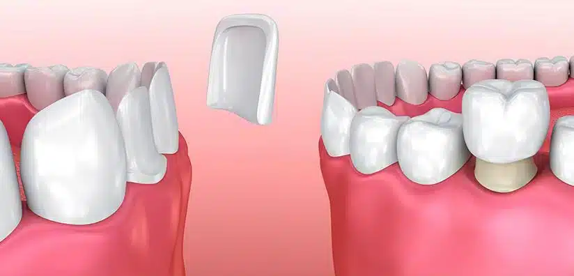 Crowns vs Veneers