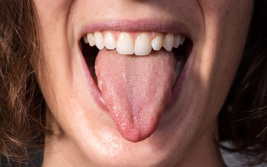 Why Do I Keep Getting Bumps On My Tongue?