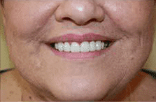 general cosmetic dentistry facial esthetics perfect smile tulsa ok after Corrected with lumineers gallery image 2
