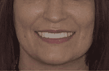 general cosmetic dentistry facial esthetics perfect smile tulsa ok after snap on smile image