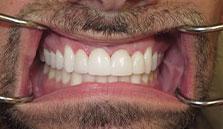 general cosmetic dentistry facial esthetics perfect smile tulsa ok after Veeners smile gallery image