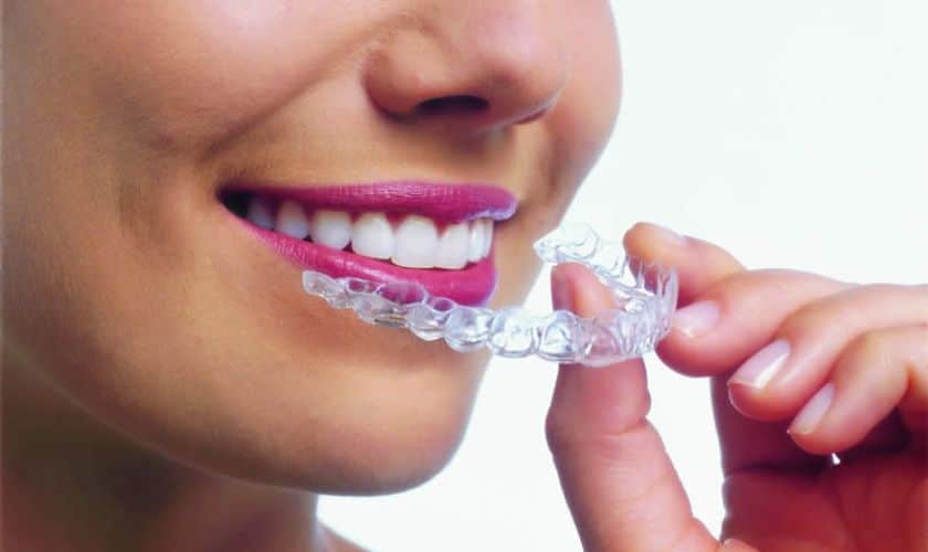 Invisalign in Tulsa - Perfect Smile Tulsa