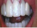 general cosmetic dentistry facial esthetics perfect smile tulsa ok before Crowns smile gallery image