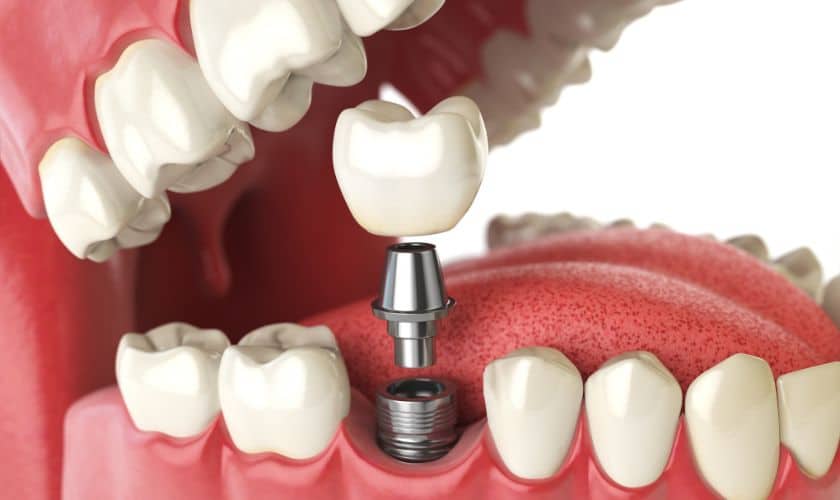 dental implants in Tulsa dental implant Tulsa