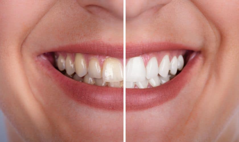 Teeth Whitening in Tulsa Brighten Your Smile: Unveiling The Magic Of Teeth Whitening