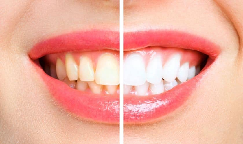 Teeth Whitening in Tulsa Teeth Whitening in Tulsa