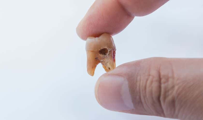 Tooth Decay In Tulsa Preventing Tooth Decay: Tips From Your Dentist In Tulsa