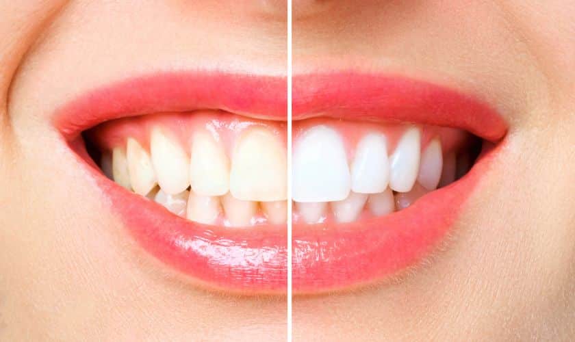 teeth whitening