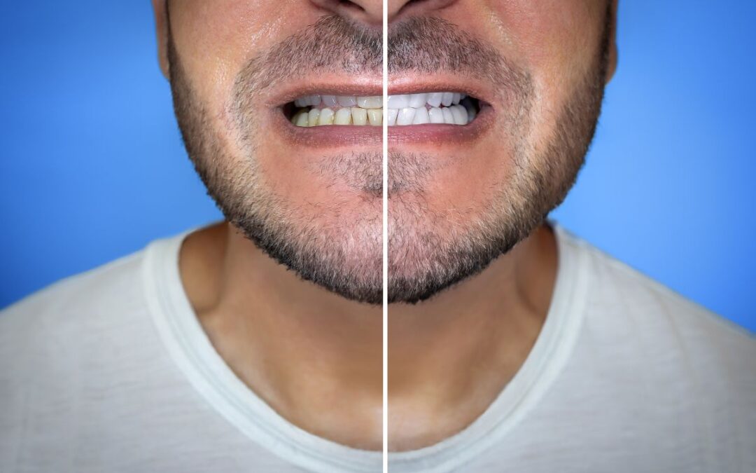 5 Things to Avoid After Whitening Your Teeth