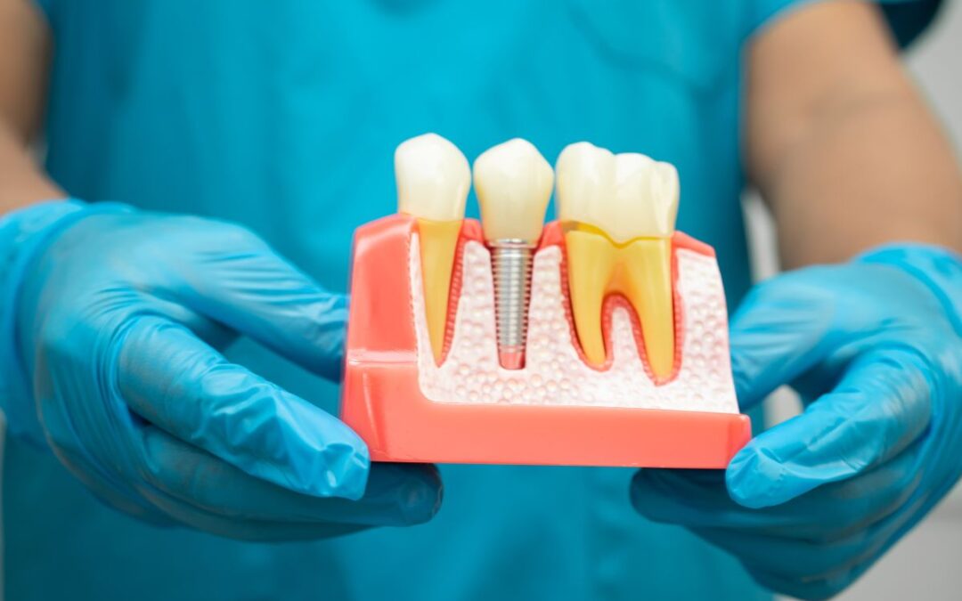 5 Myths About Dental Implants Debunked