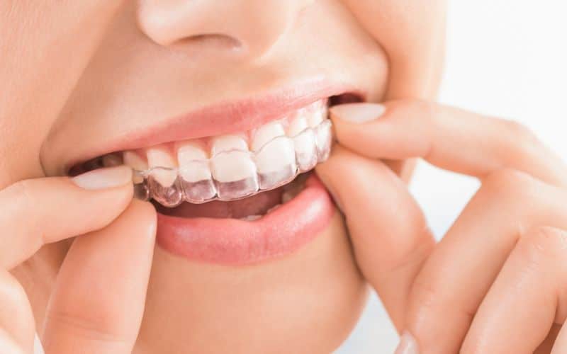 Invisalign Tulsa