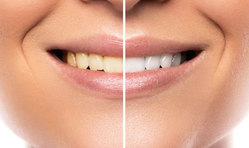 Teeth whitening in Tulsa Teeth whitening in Tulsa