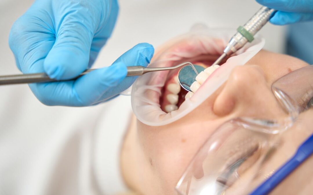 How to Care for Your Teeth After Dental Cleaning?