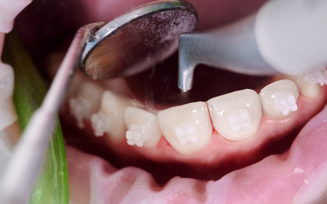 5 Tips To Keep Your Teeth Healthy and Free of Cavities