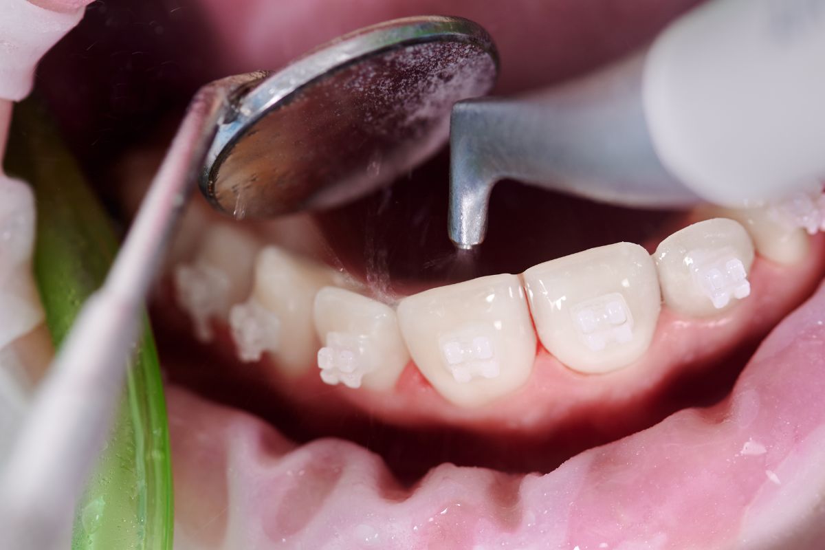 dental cleaning