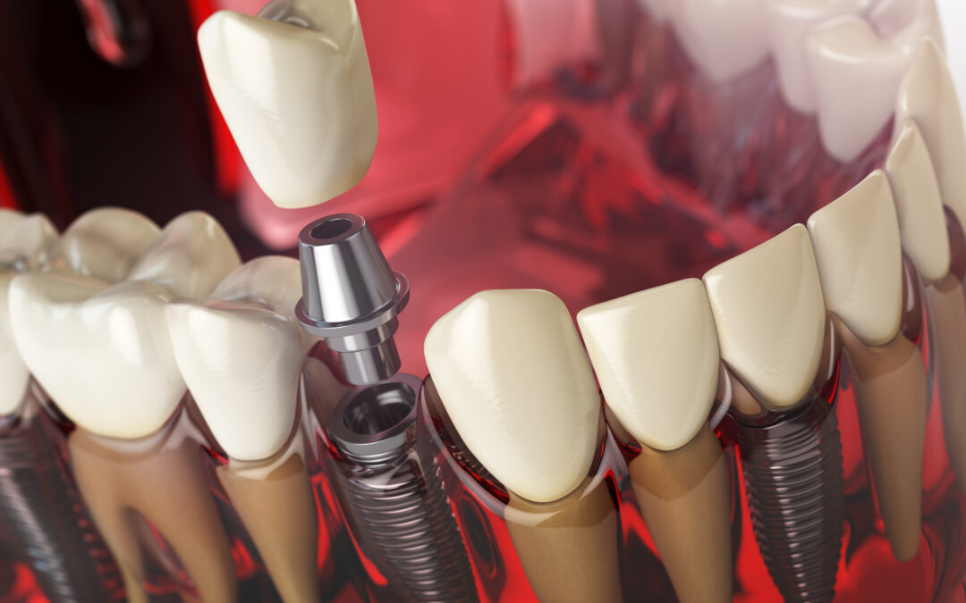 Guide to Understanding the Benefits of Dental Implants