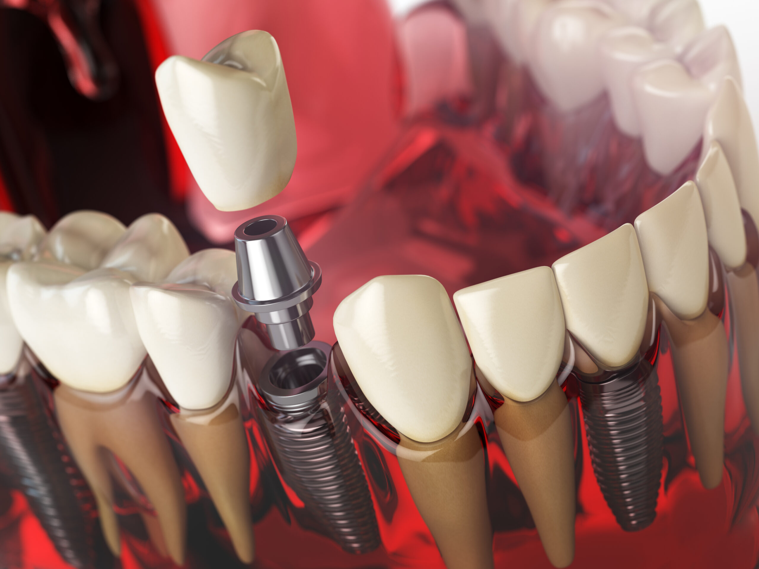 benefits of dental implants