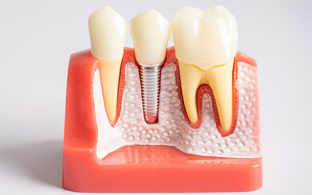 5 Signs Your Dental Implant Needs Immediate Care