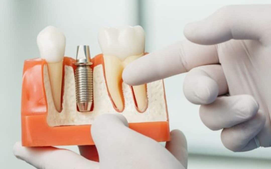 The Importance of Choosing The Right Implant Dentist