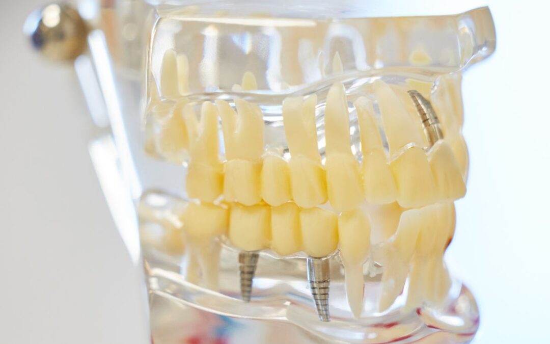 Dental Implants and Your Lifestyle: How Patients Adapt to Their New Smile?