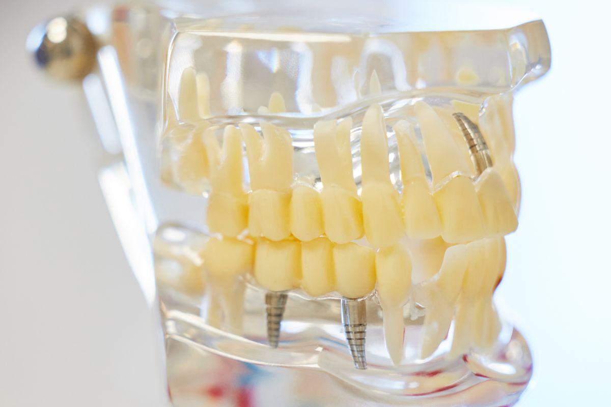 dental implants