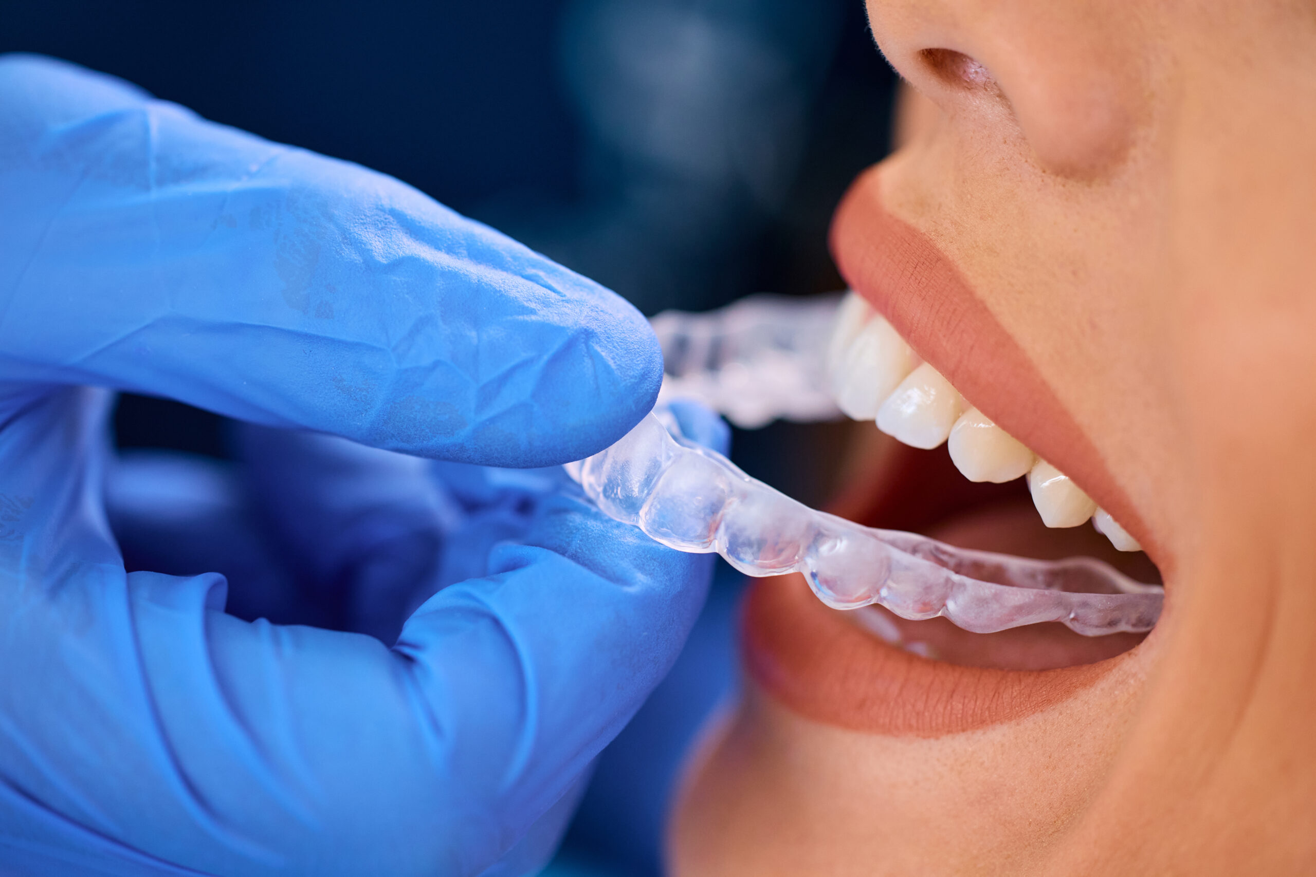 Reasons Teens and Adults Prefer Invisalign