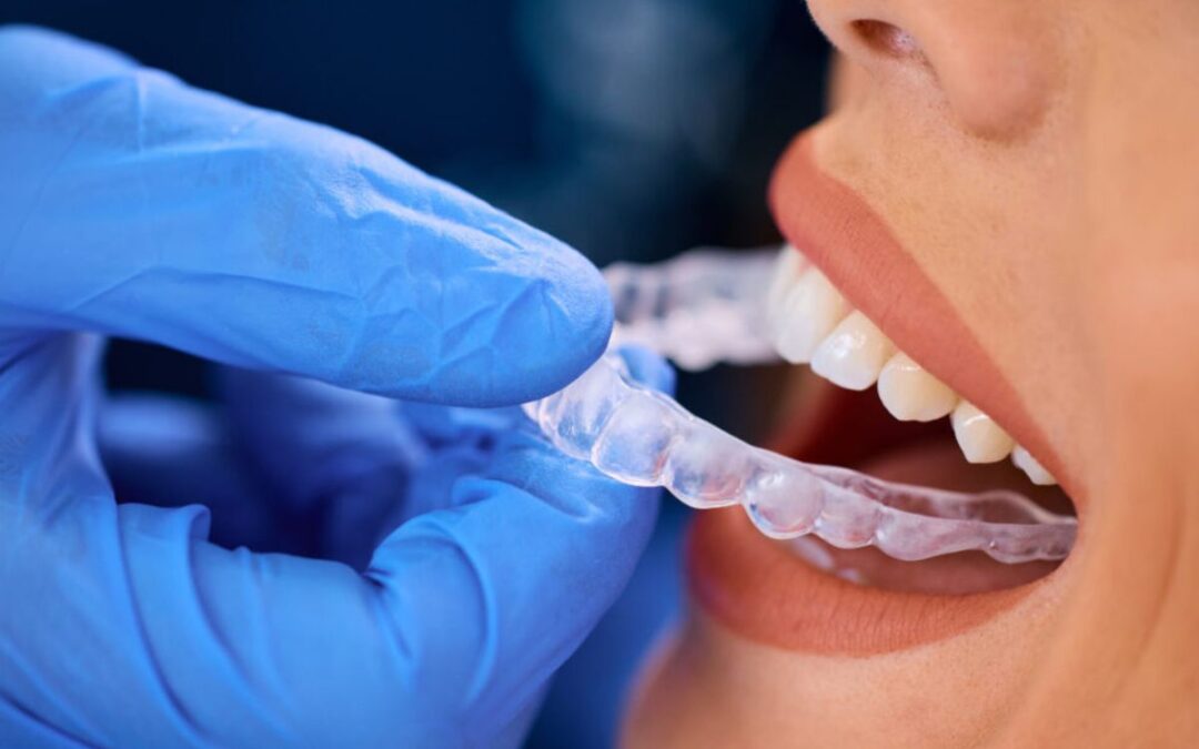 From Start To Finish: How Invisalign Treatment Works?