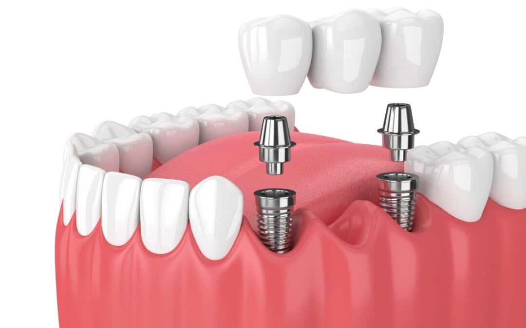 Choosing Between Single Tooth and Full-Mouth Implants