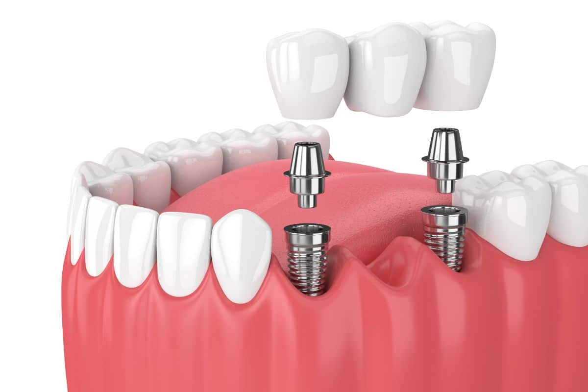Dental Implants in Tulsa