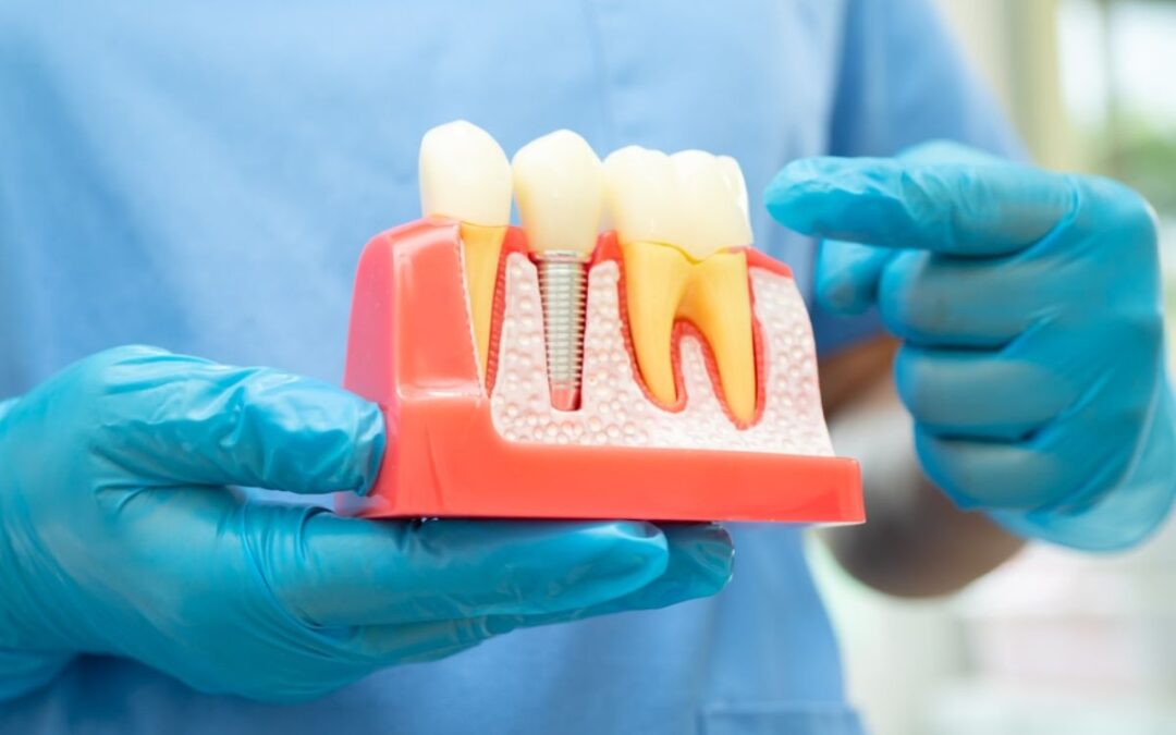 What Are the Hidden Truths About Dental Implants? Insights from a Tulsa Dentist