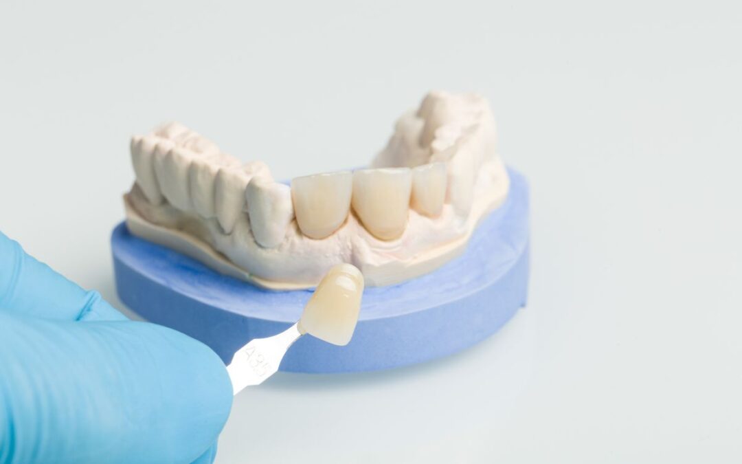 How To Affect Little Bumps in Your Dental Crown Procedure?