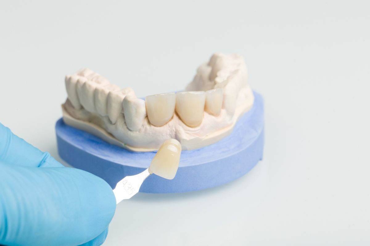 Dental Crowns in Tulsa Dental Crowns in Tulsa