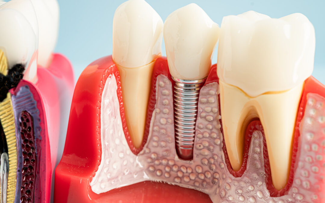 How Dentists Remove Yellow Stains From Teeth After Dental Implants?