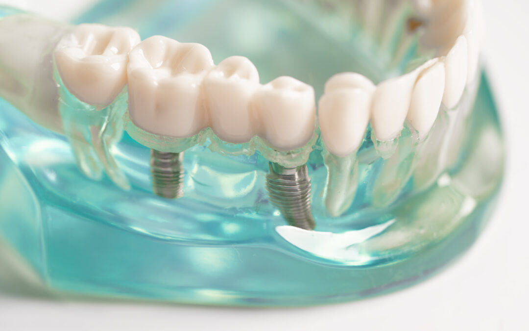 How Can I Cover My Missing Teeth with Dental Implants?