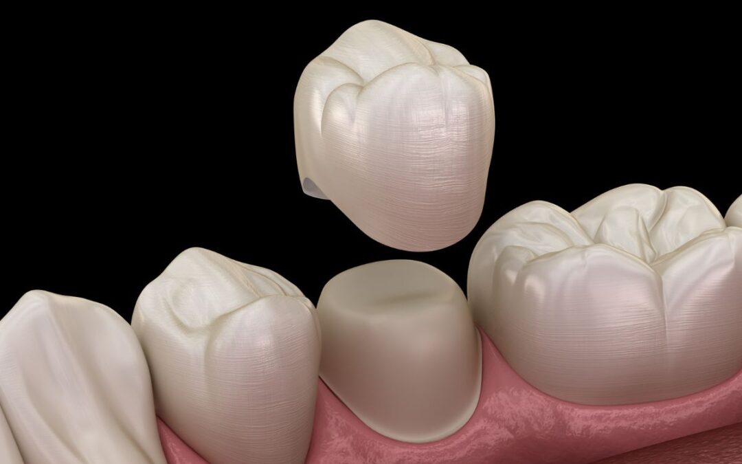 Are Dental Crowns Painful to Get or Maintain?