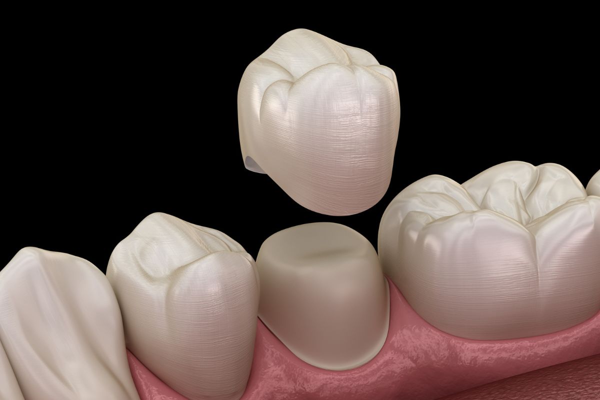 dental crown