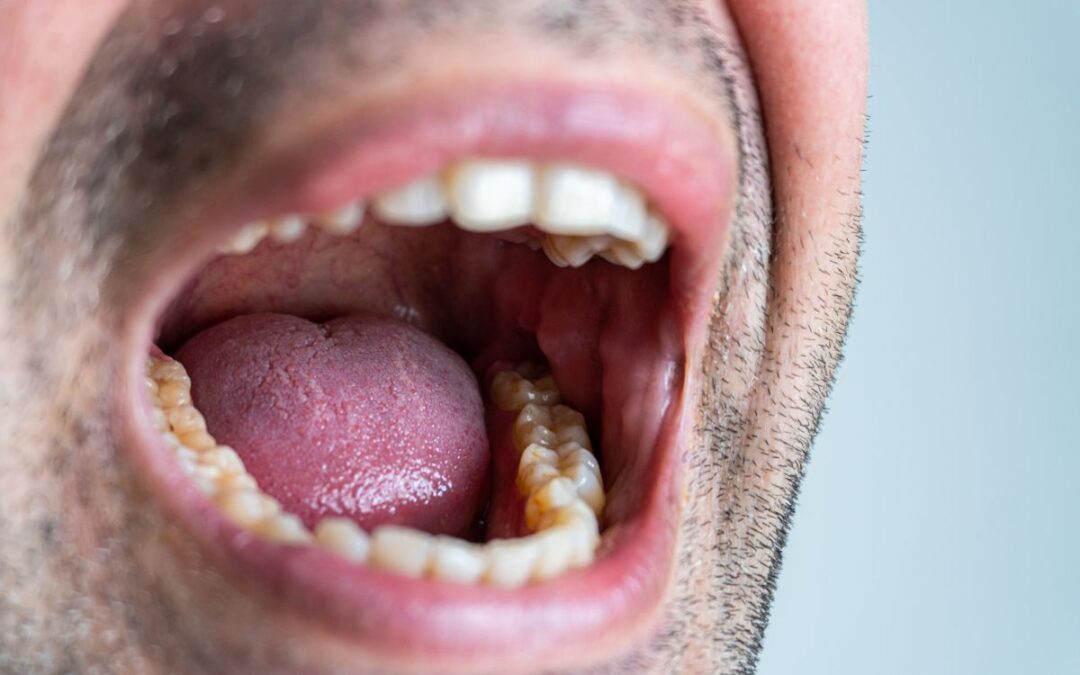 What Causes Dry Mouth and How Can You Treat It?