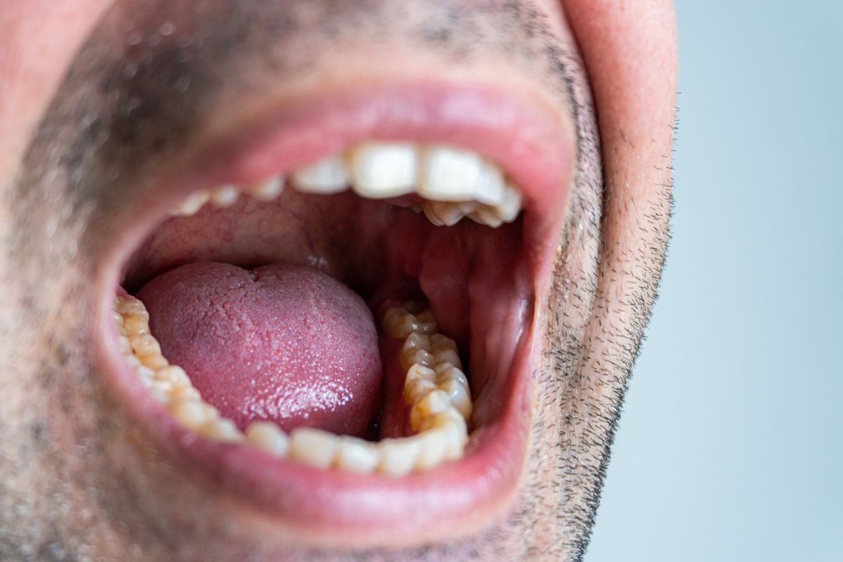 dry mouth cause of dry mouth