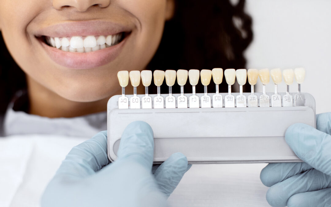 How Long Do Dental Veneers Last?