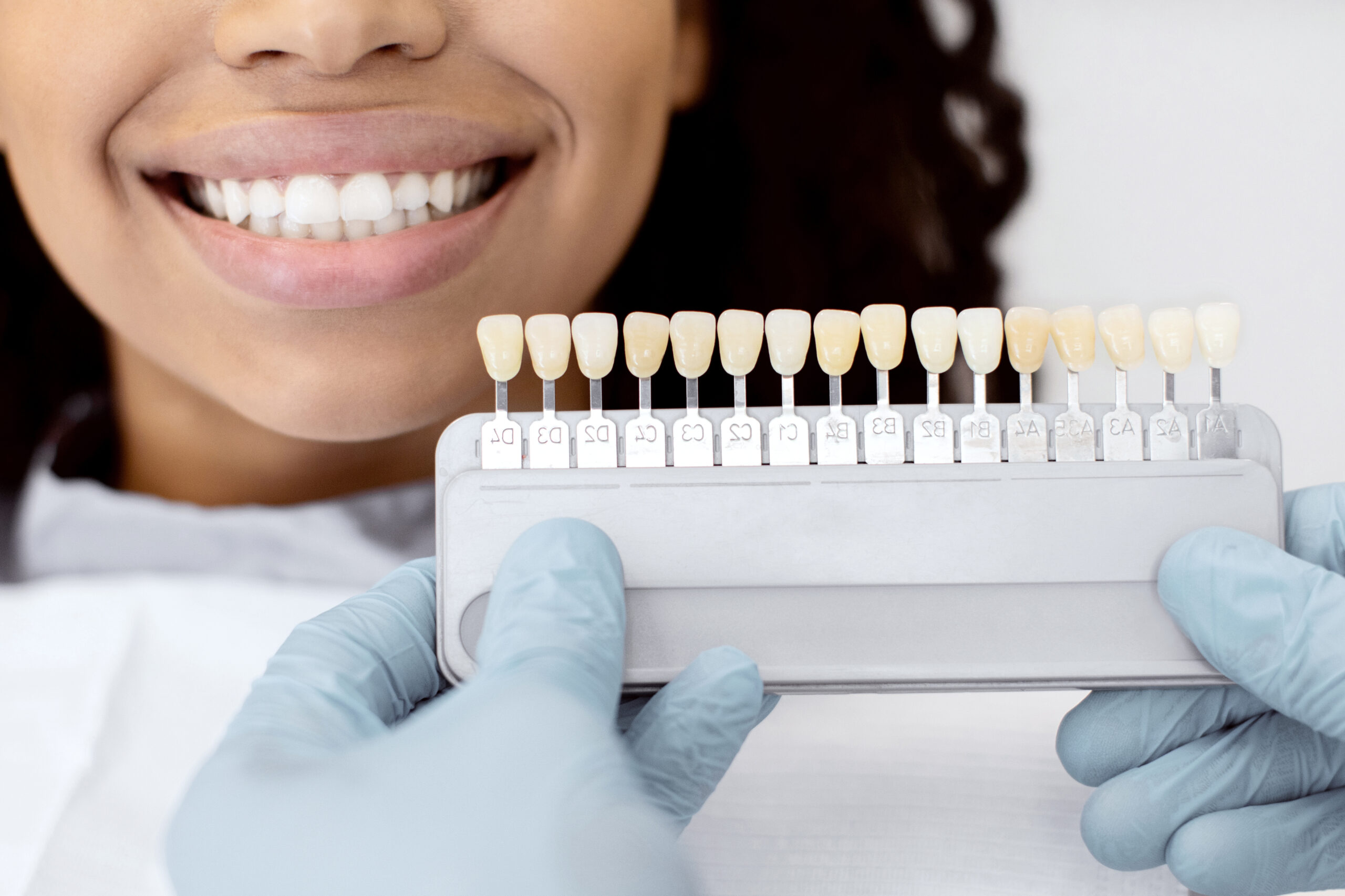 dental veneers