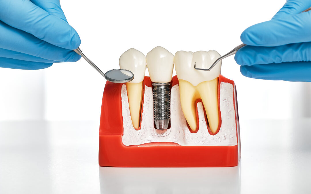 How Long After a Bone Graft Can You Get Dental Implants? A Tulsa Dentist Explains
