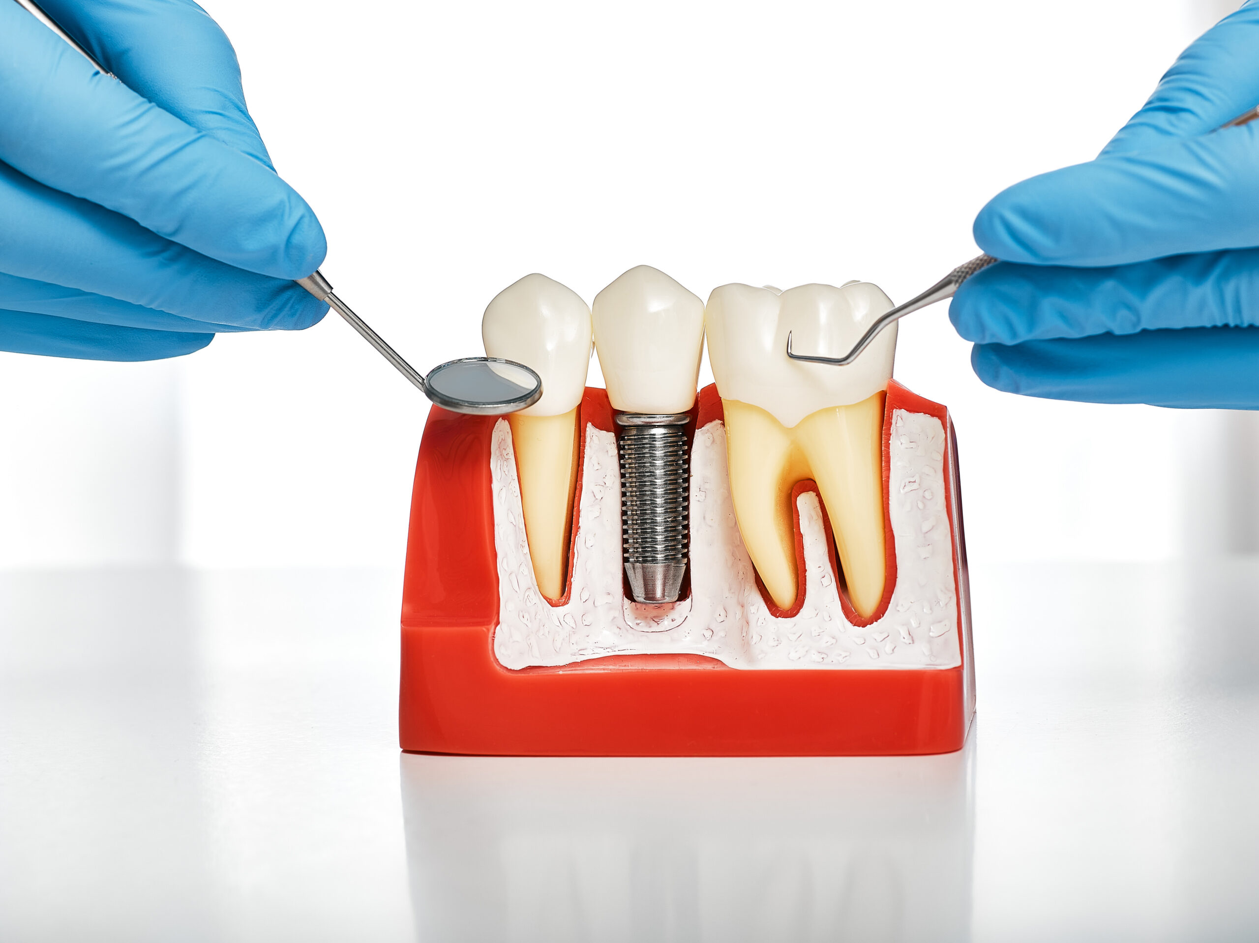 dental implants