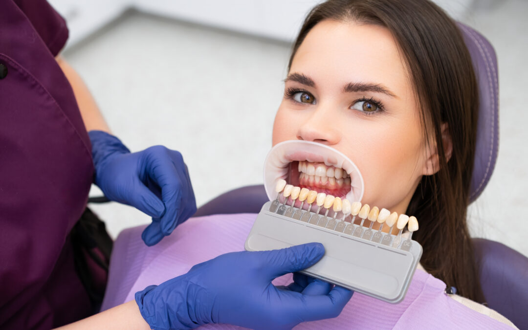 Can You Whiten Your Teeth If You Have Veneers?