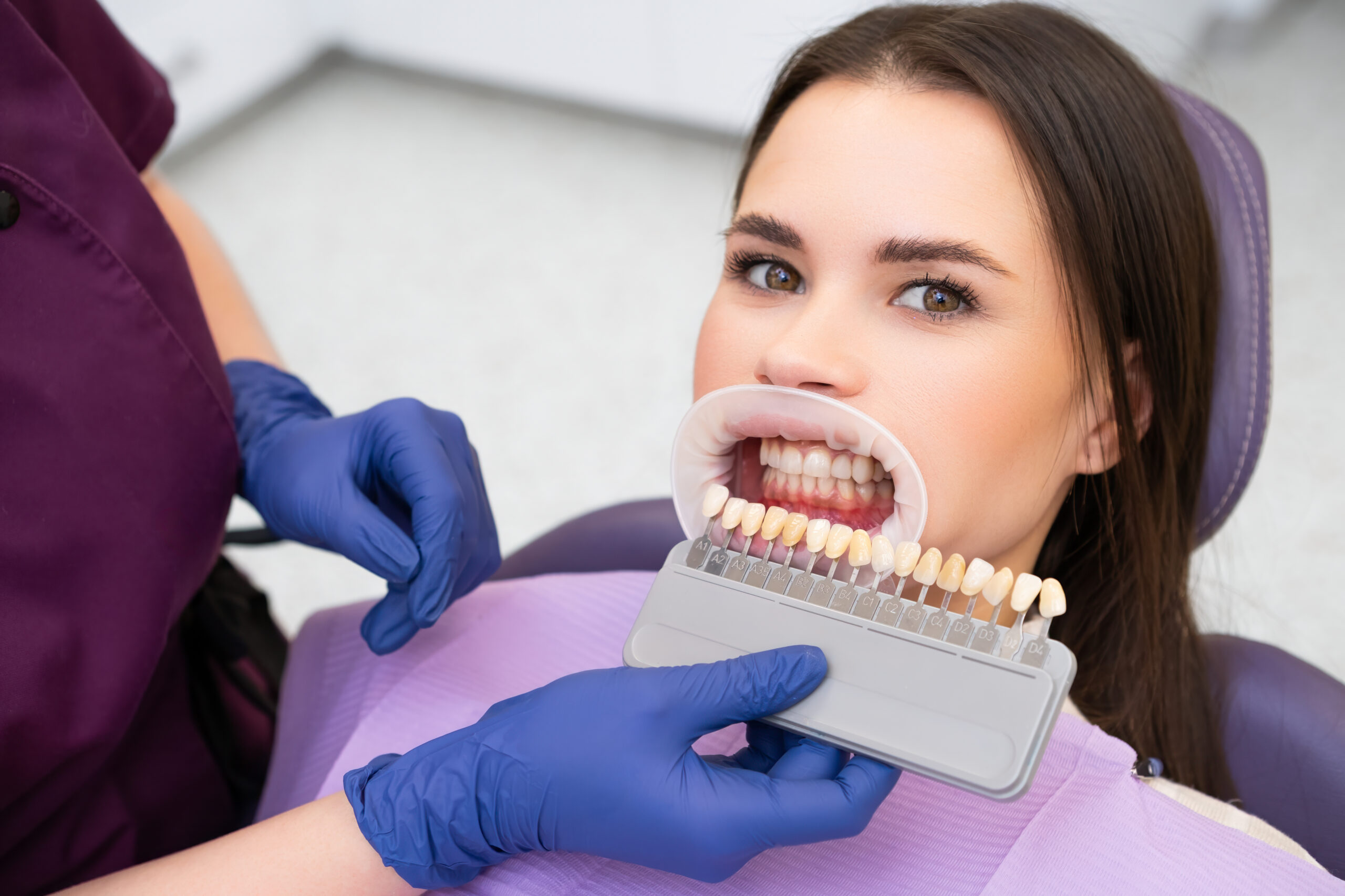 dental veneers