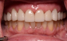 after dental veneers treatment