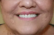 shows a significant improvement. The veneers have corrected the discoloration and misalignment, resulting in a set of uniform, bright white, and straight teeth