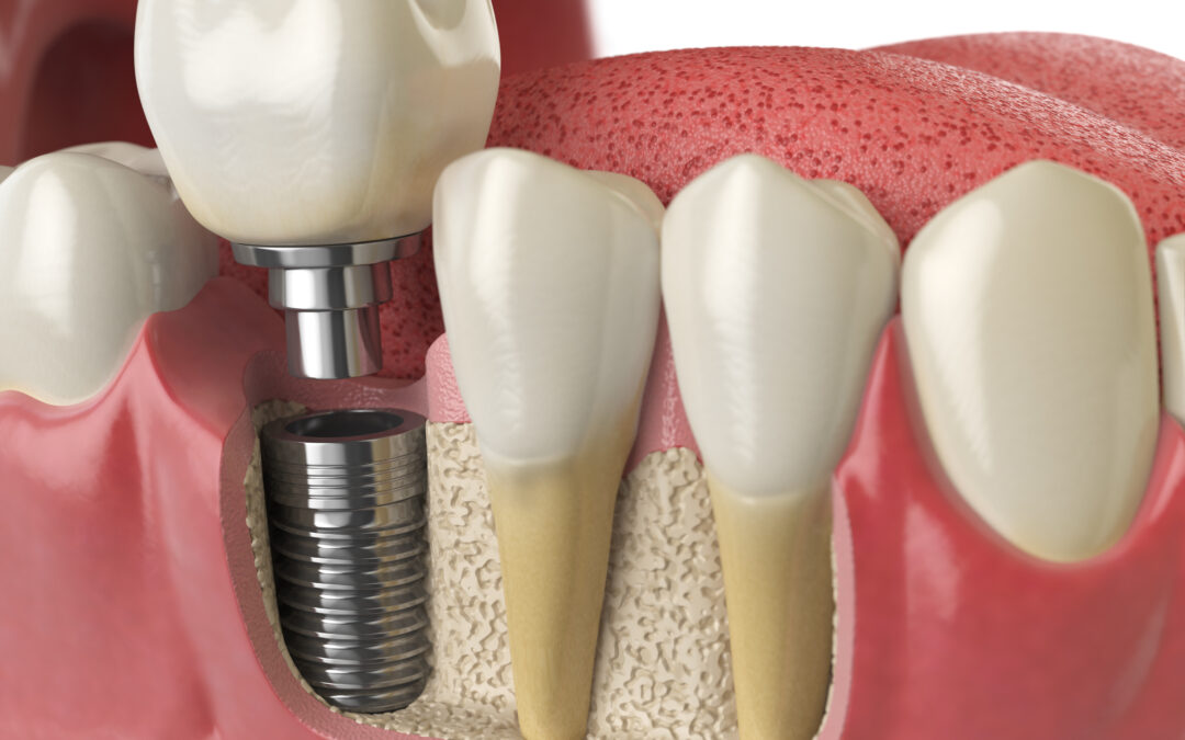 How to Address Sensitivity in Dental Implants?
