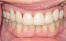 before dental veneers treatment